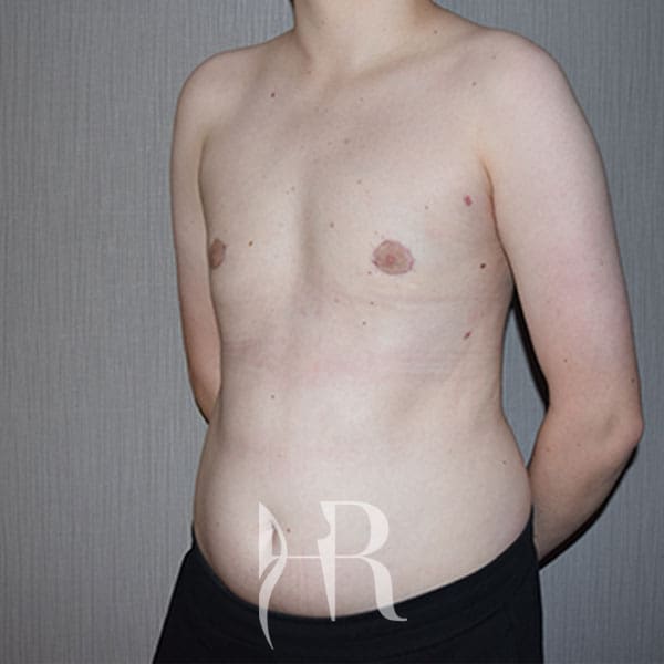 HR Plastic Surgery - Male Breast Reduction patient after 2